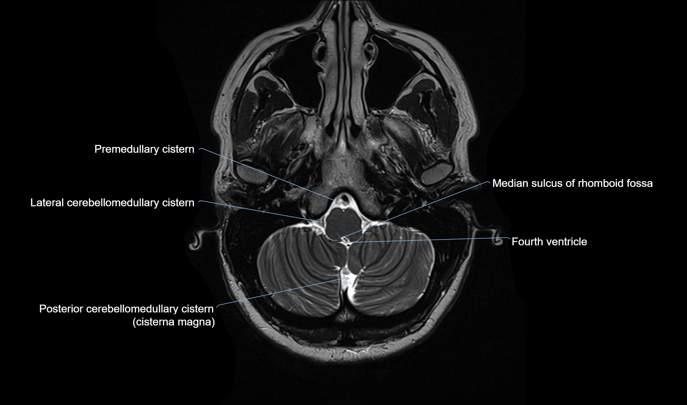 Brain cisterns  and ventricles  axial anatomy 3T MRI image-img-00001-00007.webp